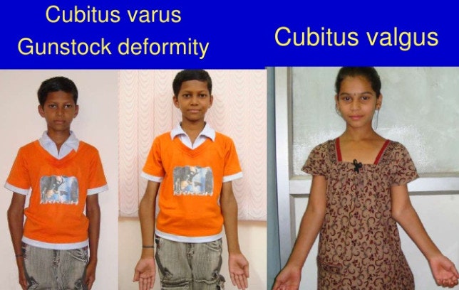 gun stock deformity(cubitus varus) : 네이버 블로그
