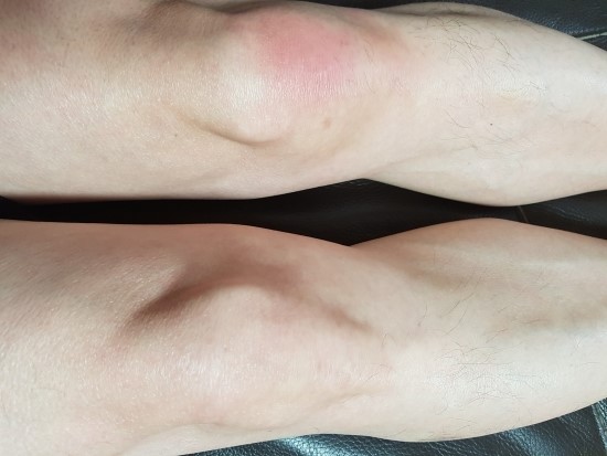 옆구리 통증 통풍 증상일 수도? 5