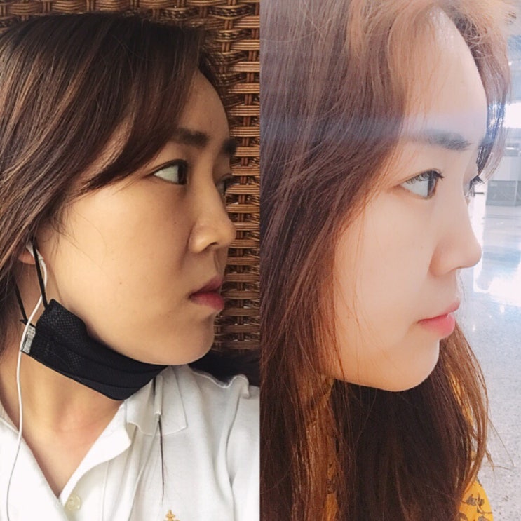  서울 압구정/신사역 치아교정 - 더스타치과/라미네이트1년4개월 마무리 솔직후기!