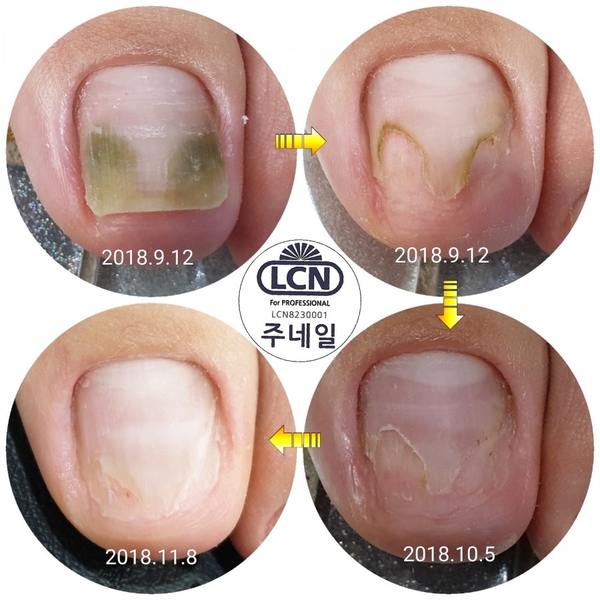 조갑박리/분당용인수원수지보정동백죽전동/주네일/파고드는내향성발톱전문네일샵 조갑박리/분당용인수원수지보정동백죽전동/주네일/파고드는내향성발톱전문네일샵