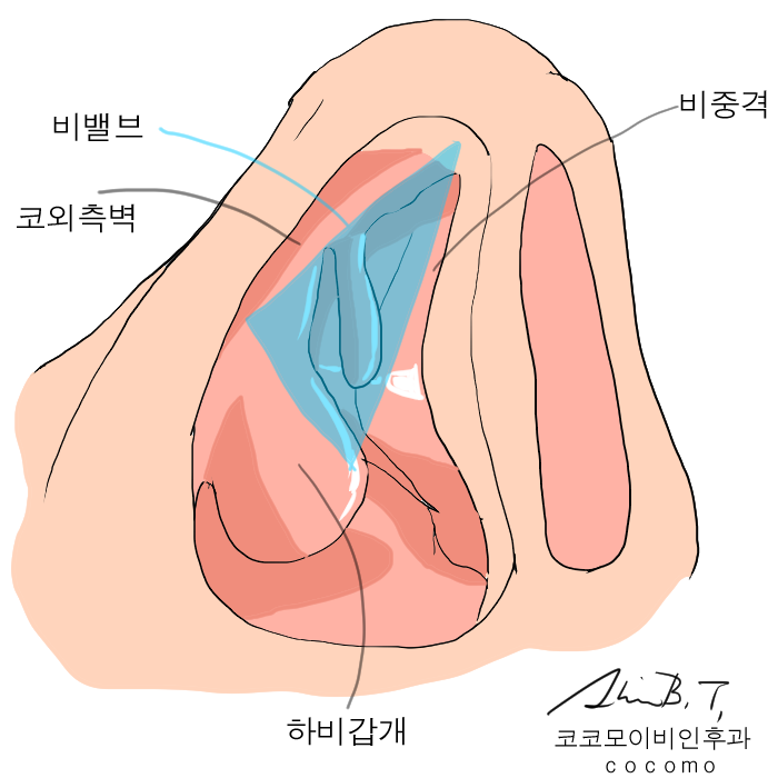  비중격만곡증 수술 술후 불편감과 통증 최소화하는 수술법
