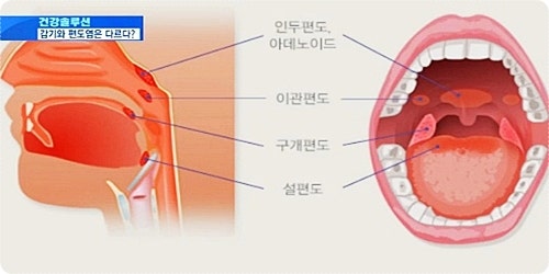 겨울철 목 관리 편도염은 이제 안녕