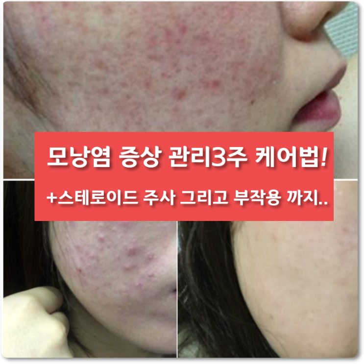  모낭염 증상 관리[3주]스테로이드주사 효과와 부작용