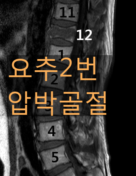 요추 2번(L2) 압박골절