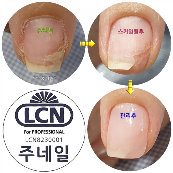 찢어진손톱밴드붙이지마세요/분당용인수원수지보정동백죽전동/주네일/문제성손발톱전문네일샵 찢어진손톱밴드붙이지마세요/분당용인수원수지보정동백죽전동/주네일/문제성손발톱전문네일샵