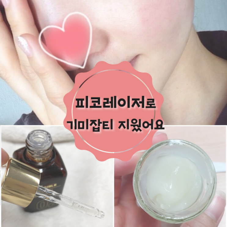  피코레이저 기미,잡티 지웠어요 피부톤 개선 꿀팁 !!