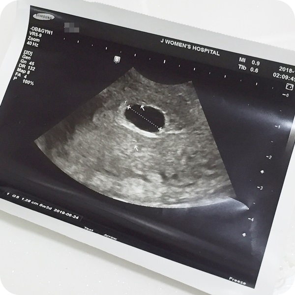  계류유산, 소파수술 후 몸조리중