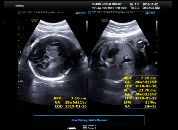 임신 28주 증상 ,임신중독증 검사, 몸의 변화