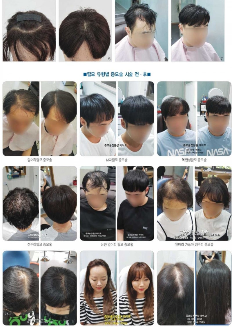 남자 헤어증모술 가격 행사 놓치면 안될것 같아요 6