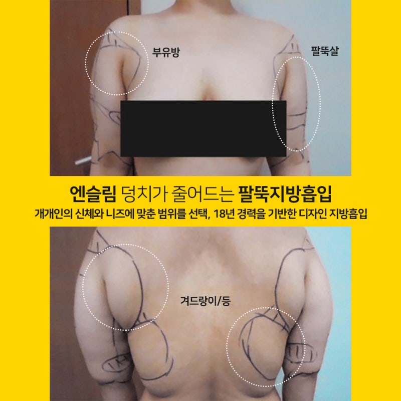 복부 지방 제거 비용 겨드랑이 덩어리 원인 및 통증 치료 병원 선택 비교 9