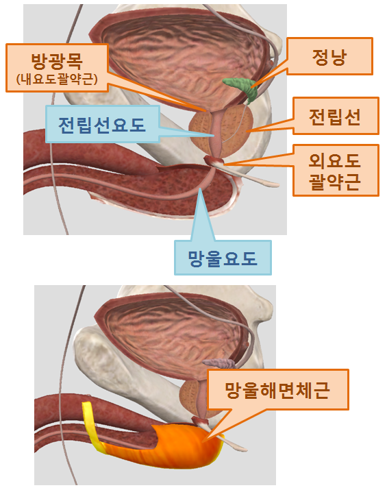  사정통의 원인- 만성 전립선염