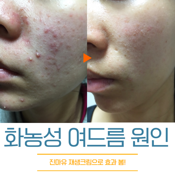  화농성여드름관리 압출 없이 연고 7주 홈케어+피지조절제