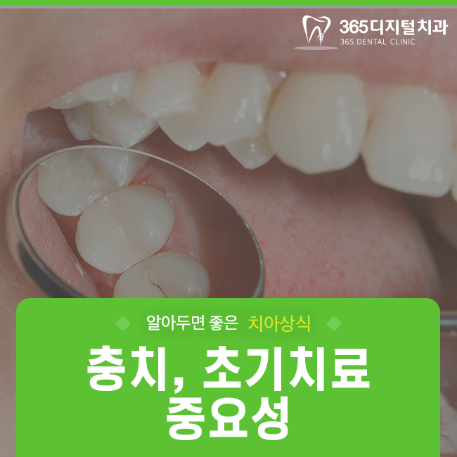 둔산동치과 충치 초기치료의 중요성!