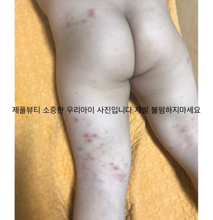  [제플뷰티X바이더닥터] 어디에도 없던 아토피 /침독/ 태열 / 습진 / 건조피부 만능 세트 OPEN / 선착순 EVENT 