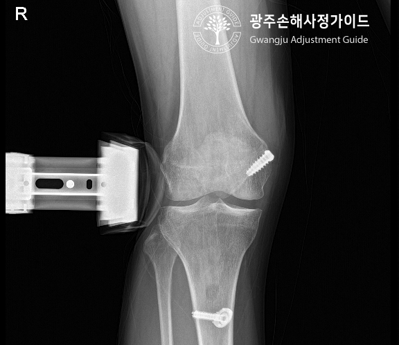 후방 십자인대파열 후유장해 보험금 알아보기! :: 광주손해사정 가이드 장한서 손해사정사