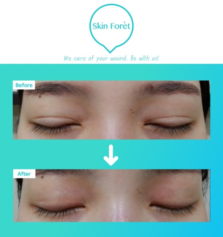   쌍꺼풀흉터피부/쌍꺼풀절개흉터피부/쌍꺼풀절개라인/흉터피부스킨케어"스킨포레"