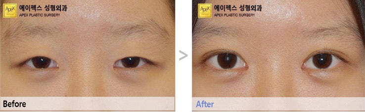 에이펙스 또렷한 눈매교정!