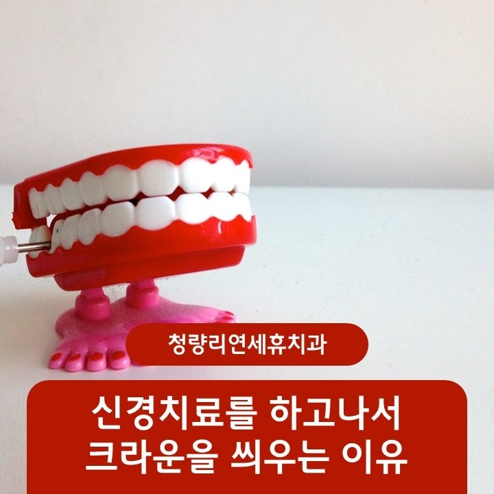회기치과 크라운 치료가 궁금해요!