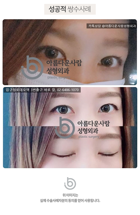 쌍수 매몰절개 차이, 망하지 않는 방법까지 공개(전문의견) 2