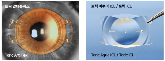 난시교정 고민이라면 렌즈삽입술!