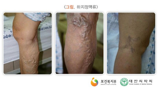  간호학 문헌고찰 하지정맥류 정의 원인 하지정맥류 증상 종류 치료 하지정맥류 수술 케이스