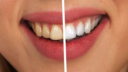 수능 이후에 치과에서 치아미백을 많이 하는 이유는 뭘까?