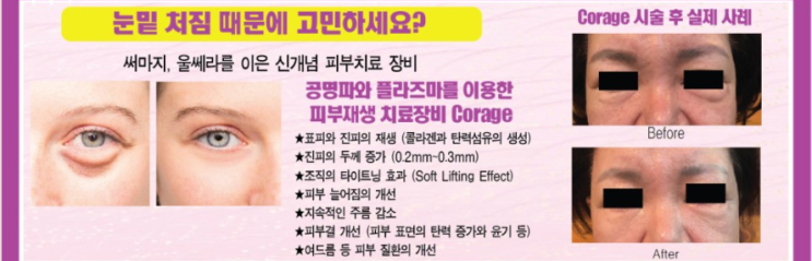  눈밑 처짐 때문에 고민하세요?
