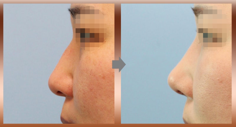 무보형물코성형복비의원인을하나씩제거하자 6