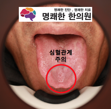 명쾌한 설진 이야기> 알콜성 간경화 초진환자 2명 설진패턴 분석 (사진 역하신 분 패스) : 네이버 블로그
