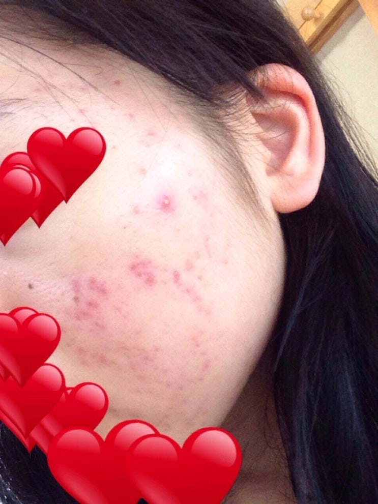  모낭염 치료 항생제 없이 콕콕앰플로 완치