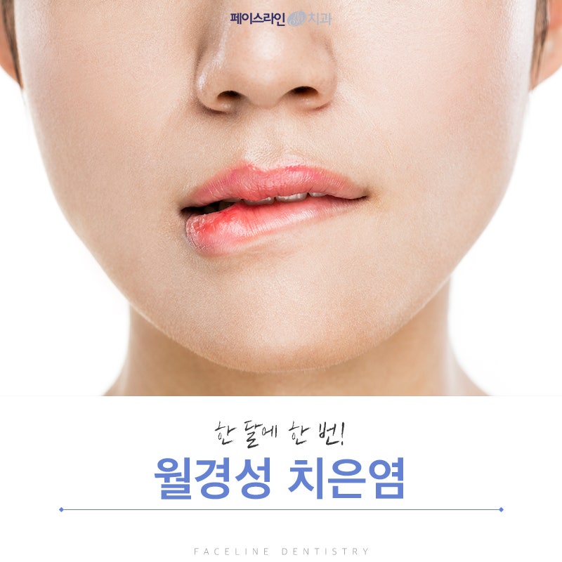 한 달에 한 번, 월경성 치은염