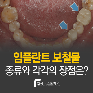 부천상동 임플란트 보철 종류, 나에게 맞는 임플란트 보철물은?