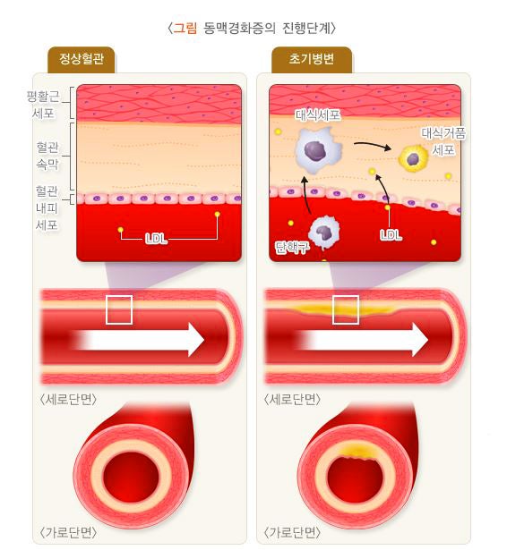 급성 심근경색 초기증상 원인 치료 예방법 알아보기 8