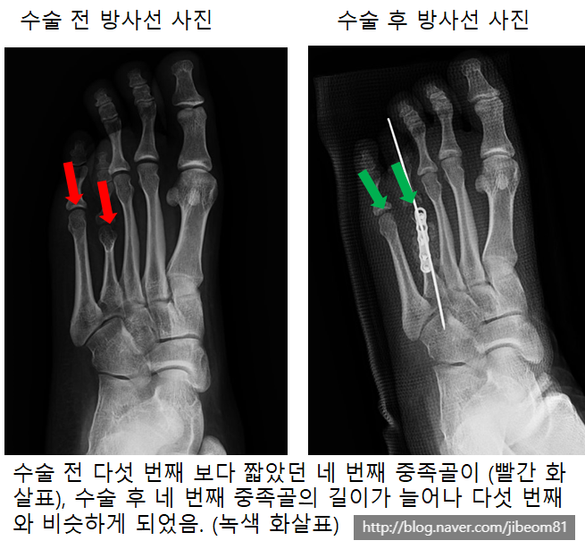 네번째 발가락 단지증의 수술 실제 사례: 짧은 네번째 발가락 치료의 실제 사례. 네번째 발가락이 짧아요. 양말 벗기가 창피해요 ...