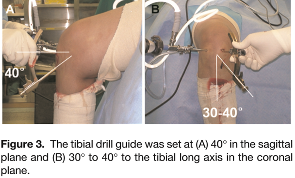 Modified transtibial technique with varus and internal rotation of the ...