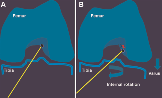 Modified transtibial technique with varus and internal rotation of the ...