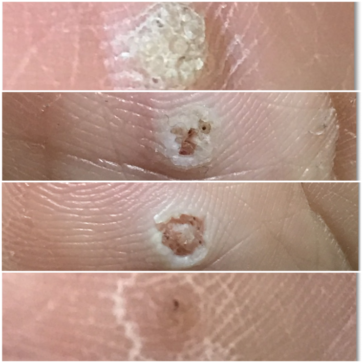  발바닥 티눈 제거 레이저치료X(변화有)