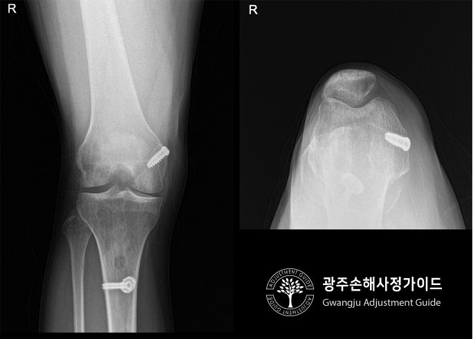 무릎 (전방십자인대 파열로 인한 동요관절) 후유장해 보험금 :: 광주손해사정 가이드 장한서 손해사정사