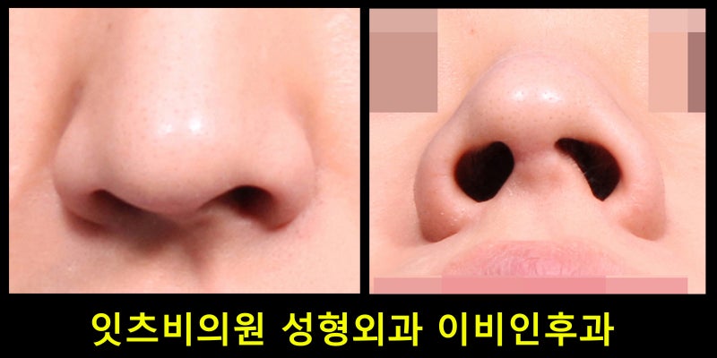 코중격만곡증 재수술 코막힘 불편하면 7