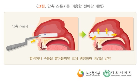 코피(비출혈) 원인과 치료법 : 네이버 블로그