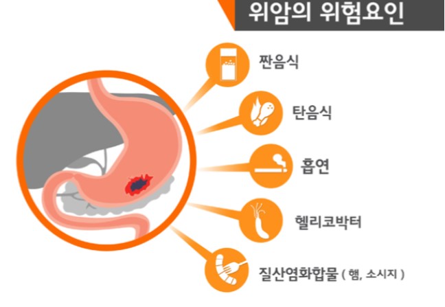  (송탄 서울아산 내과) 위암/ 위 내시경/ 위암검진
