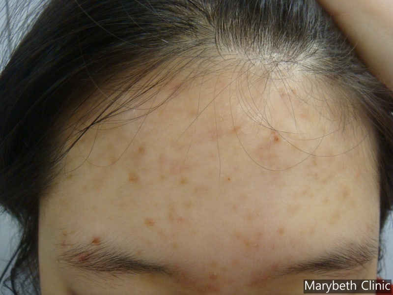 염증후과색소침착(Postinflammatory hyperpigmentation, PIH) - 메어리벳의원 정종영 원장 : 네이버 블로그