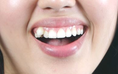 강남역 치과 중에 올세라믹으로 덧니 교정을 잘 하는 곳은?