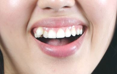  강남역 치과 중에 올세라믹으로 덧니 교정을 잘 하는 곳은?