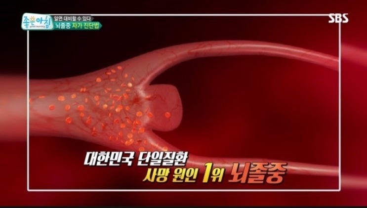  뇌졸중 징후라고 하네요 이런분 발견하면 꼭 도와주세요