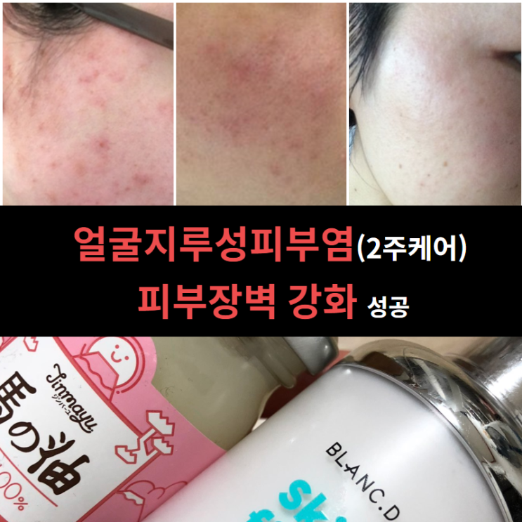  얼굴지루성피부염 (2주케어)피부장벽 강화 