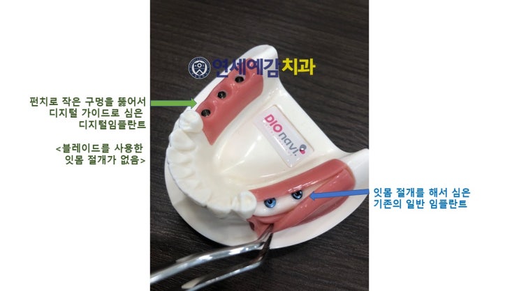  시청역 연세예감치과 디지털임플란트우수시술병원 선정 & 네비게이션 임플란트