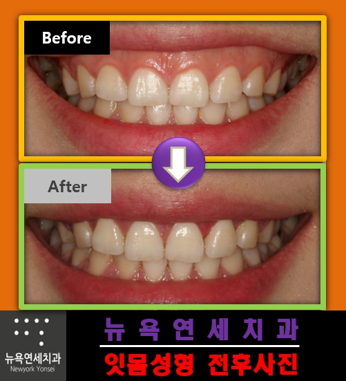  구강전정술로 잇몸성형 수술을 한 전후 사례들 알아 보기