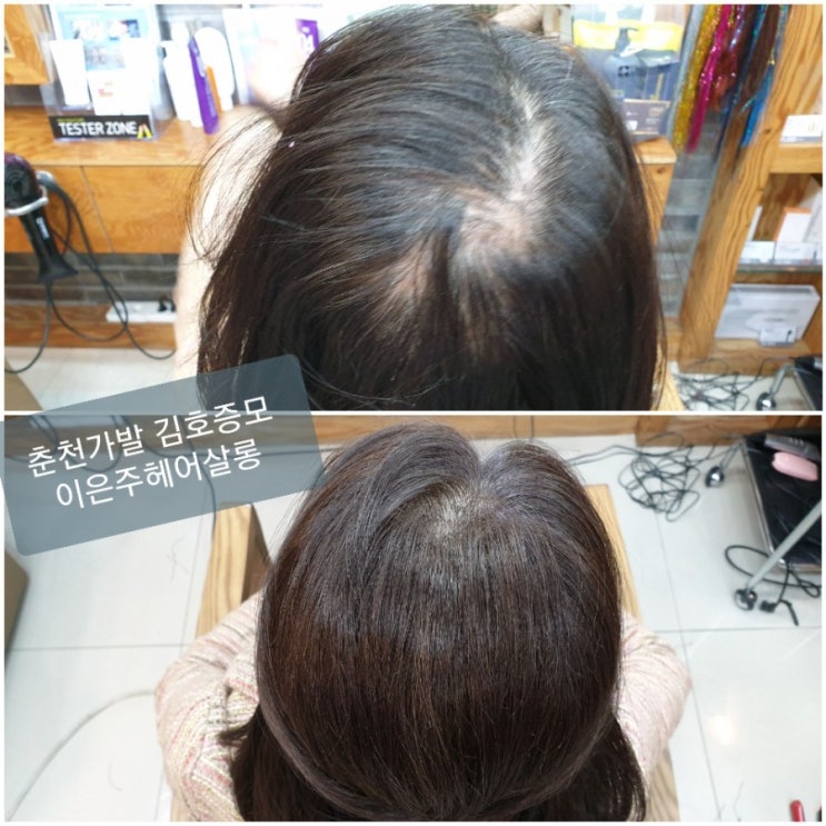  스트레스성 탈모고민으로 알아본 흰머리생성원리와 예방법 춘천가발 김호증모 가르마.정수리 탑가발로 해결합니다~^^