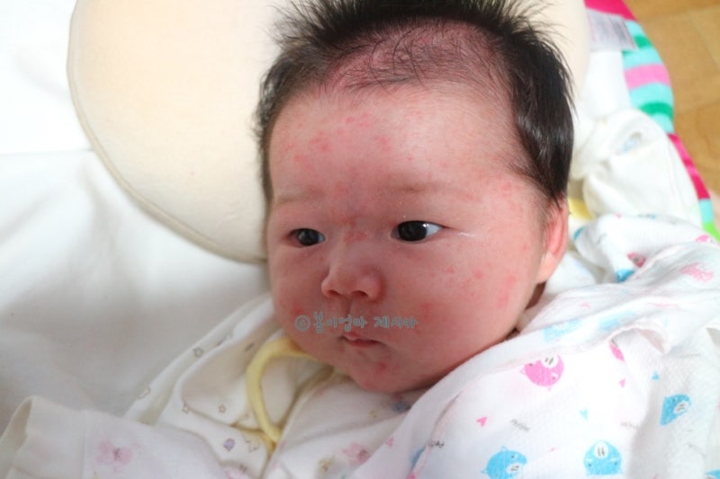 돌 이후 많이 좋아진 아기 얼굴 피부 (아토피/침구/피부염/보습제 리뷰)